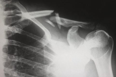Workers Compensation Attorney human X-ray result chart accident injury